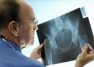 5 Tips to a Successful Hip Replacement Recovery